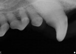 Dental X-ray Right Bitewing Dental X-ray Right Bitewing